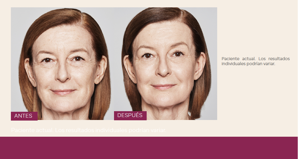 Sculptra Antes y Después